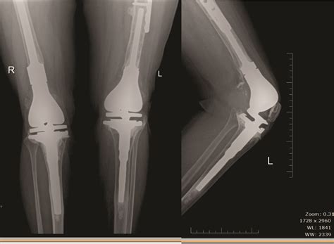 Distal Femoral Fractures: Complications and How to Avoid them? – Trauma International