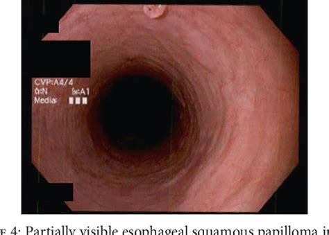 Figure 4 from Squamous Cell Papilloma of the Esophagus: A Case Series Highlighting Endoscopic ...