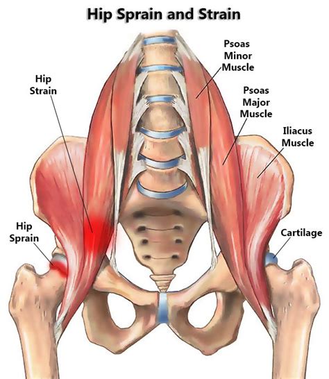 Hip Sprain and Strain Specialists in NYC | New York Pain Care