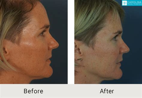 Fillers for Lip Lines - Carolina Facial Plastics