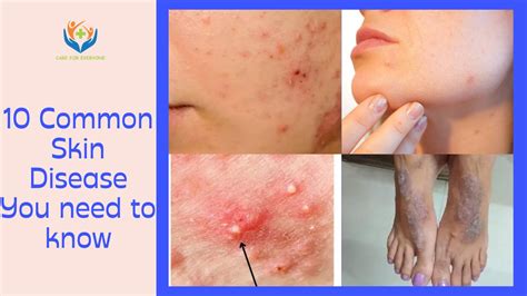 10 Common Skin Disease You need to know - JAYYUSH HOSPITAL