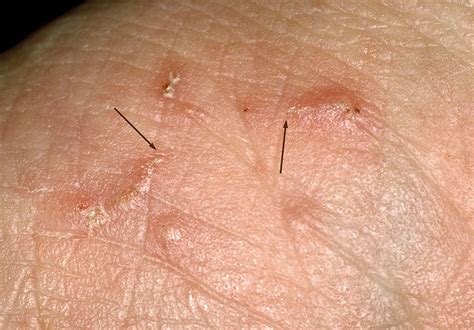 Scabies Diagnosis And Management Bpacnz 5070 | The Best Porn Website