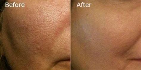 before and after large pores #HowToGetRidOfAcneScars #minimizeporesnaturally | Skin care pimples ...