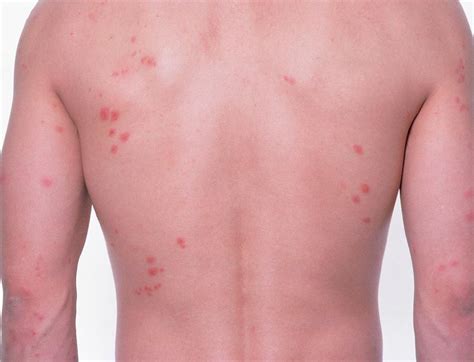 Bed Bug Bites On Person's Back Photograph by Science Photo Library