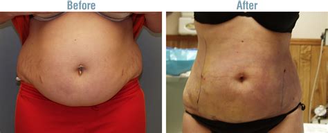 Dayton Lipo and Laser Lipo Plus