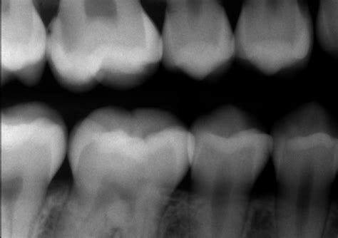 Predictably Managing Deep Carious Lesions - Spear Education