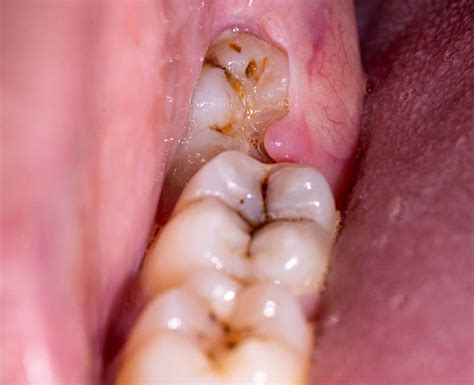 Impacted Wisdom Teeth: Symptoms, Signs, Removal & Recovery