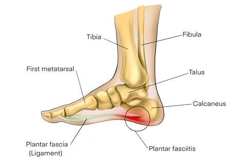 Plantar Fasciitis: Causes, Symptoms, and Relief – Holabird Sports