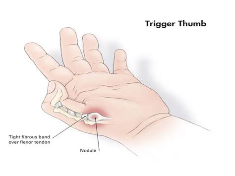 Trigger Thumb gone!