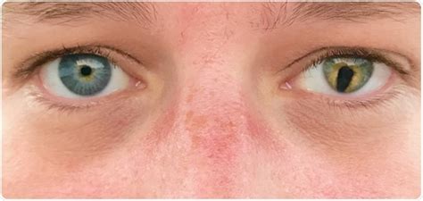 What Causes Coloboma?