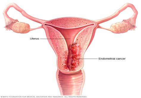 Uterine Cancer (womb, endometrial cancer) | Symptoms, Stages