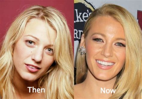 Blake Lively Plastic Surgery Before and After Photos