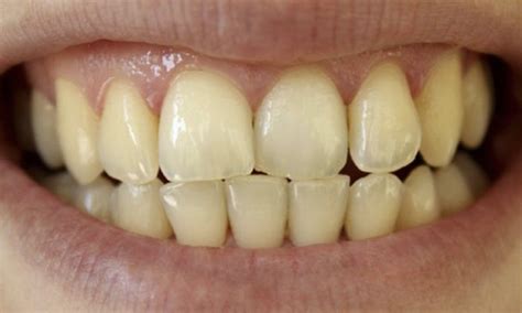 Stains on Teeth: Causes, Treatment and How to Prevent | What to wear ...