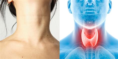 9 Signs Of Thyroid Problems | SELF