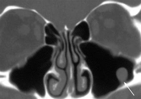 Maxillary Sinus: Abnormal | Sinusitis, Abnormal