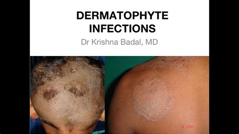 Dermatophyte infections of Skin - YouTube