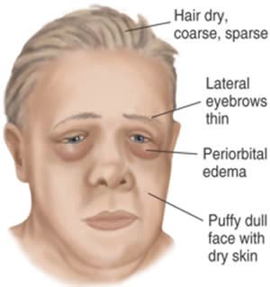 Hypothyroidism Face Swelling