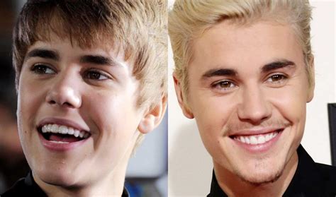 Top 10 Celebrities Who Have Used Invisalign and Braces