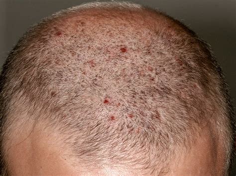 Otherwise Rust Arab cancer spots on head Pub welfare Relatively