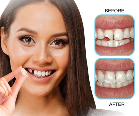 SmileFix Thermal Forming False Teeth - Wizzgoo.com