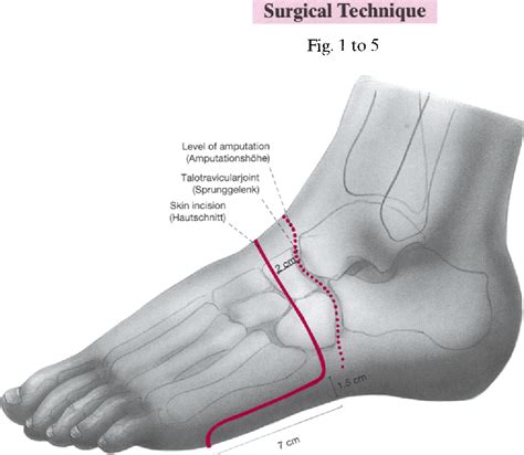 The augmented chopart amputation in children | Semantic Scholar