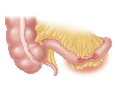 Heineke Mikulicz Strictureplasty in Crohn's Disease on Behance