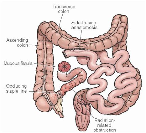 Ileostomy And Mucous Fistula