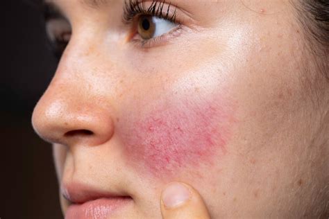 consumirse Idealmente heroína cremas para rosacea en la nariz cavidad ...