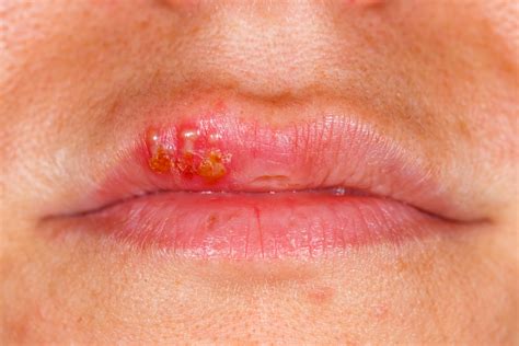 Are Cold Sores On The Lips Herpes | Lipstutorial.org