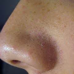 Pimple - Wikipedia
