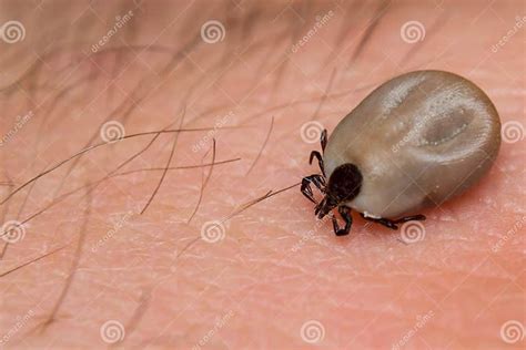 Fat tick on human skin stock image. Image of skin, lyme - 148977625