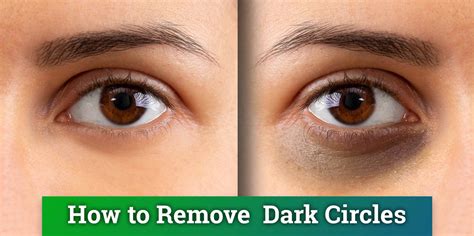 Effective Natural Remedies To Get Rid Of Dark Eye Circle In Indiana - Lopare