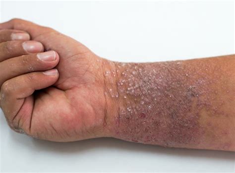 Eczema (Atopic Dermatitis) — Medical Secrets