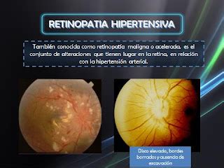 POSTGRADO DE NEUROCIRUGÍA - HOSPITAL CENTRAL DE MARACAY - VENEZUELA: Fondo de Ojo Normal y ...