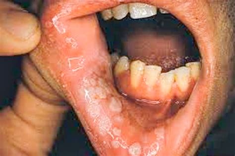 Sexually transmitted diseases that affect the mouth - Searchlight