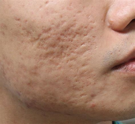 Why You Should Never Pop Your Pimples. | SiOWfa16: Science in Our World ...