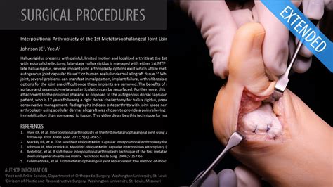 Arthroplasty of the 1st MTP Joint Using Acellular Allograft - Extended (Feat. Dr. Johnson) - YouTube