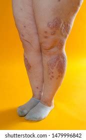 Dermatological Skin Disease Psoriasis Eczema Dermatitis Stock Photo 1479996842 | Shutterstock