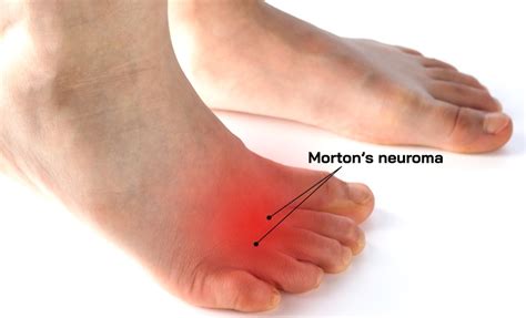 Pain in the foot: Morton’s Neuroma l Manchester Burnley