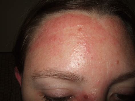 Skin Rash On Forehead Pictures