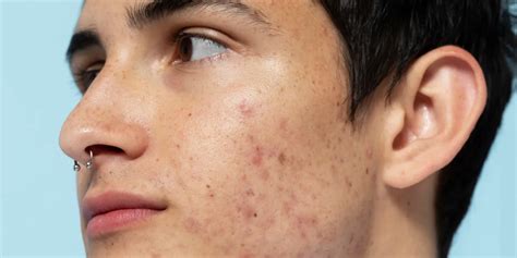 When is the best time to treat acne scars?