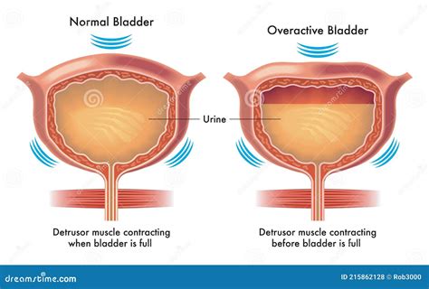 Normal and Overactive Bladder Stock Vector - Illustration of artwork, decorating: 215862128