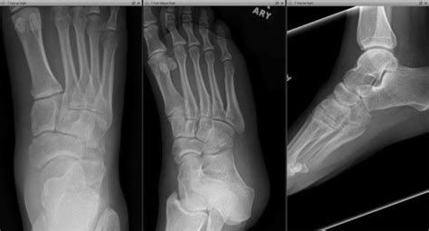 Surgical Management Navicular and Cuboid Fractures - Clinics in Podiatric Medicine and Surgery