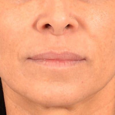 Lip Lift Before & After Photos | Page 2 | Starkman Facial Plastic Surgery
