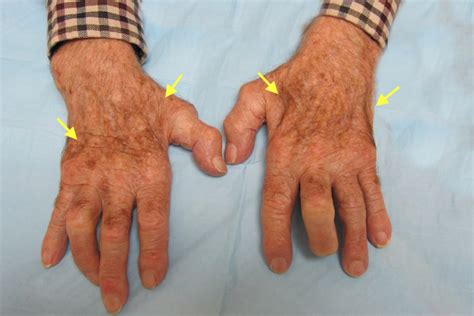 Ulnar Intrinsic Atrophy | Hand Surgery Resource