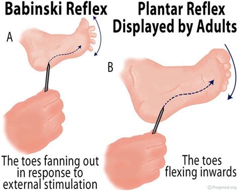 Plantar Reflex Baby