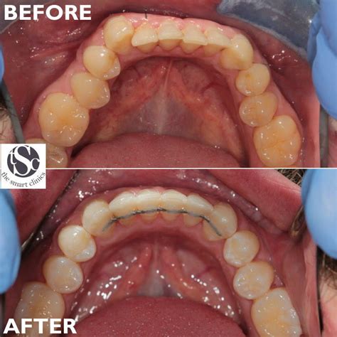 before and after fixed retainer | The Smart Clinics