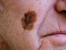 Lentigo Maligna Melanoma (LMM) Skin Cancer Treatment Houston TX, Spring