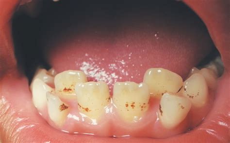 Brown Spots On Teeth: Cavity Or Stain? - Bradford Family Dentistry