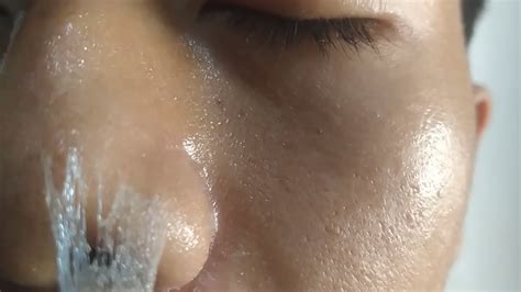 NOSE SKIN PEELING CONTINUOUSLY - YouTube